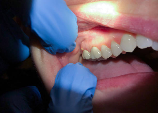 Best Same-Day Emergency Dental Services in Fruitdale, CA
